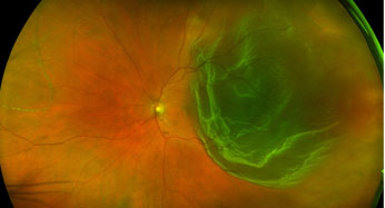 Conditions treated by Lipman Mandell Retina Center | Virginia Beach Retina Specialists